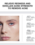 SKINEVER Salicylic Acid Acne Treatment Ice Sleep Masque
