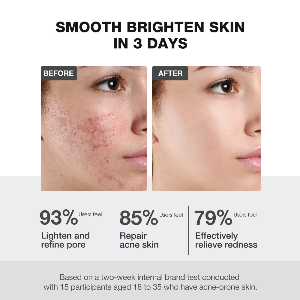 SKINEVER Salicylic Acid Deep Pore Cleansing Masque